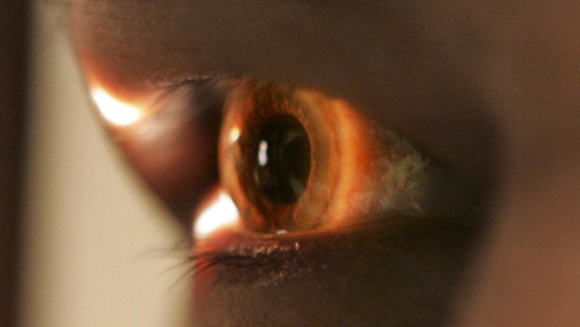 Tucson startup raises $1M to advance system to improve glaucoma treatment